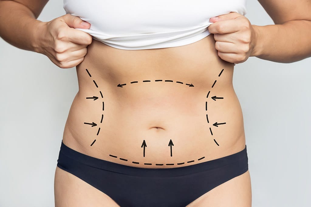 Top liposuction surgeon in Hyderabad